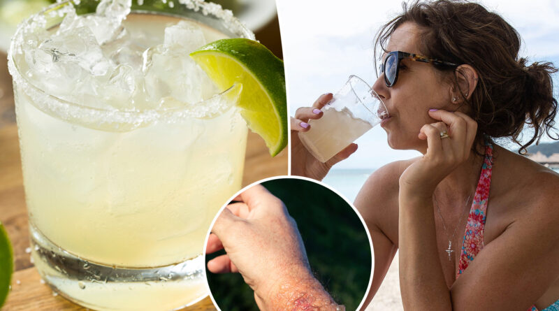 Beware ‘margarita burn’ — this common summer ailment can leave you howling in pain