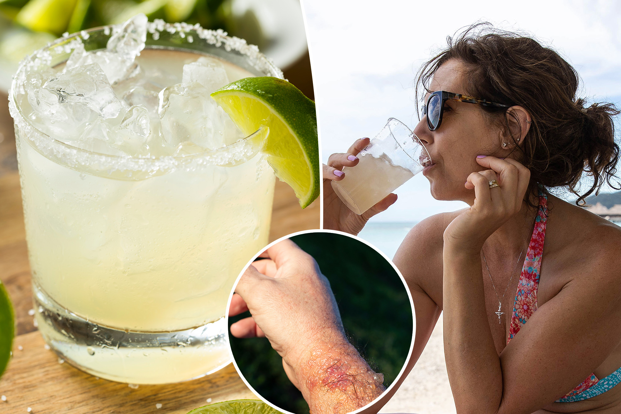 Beware ‘margarita burn’ — this common summer ailment can leave you howling in pain