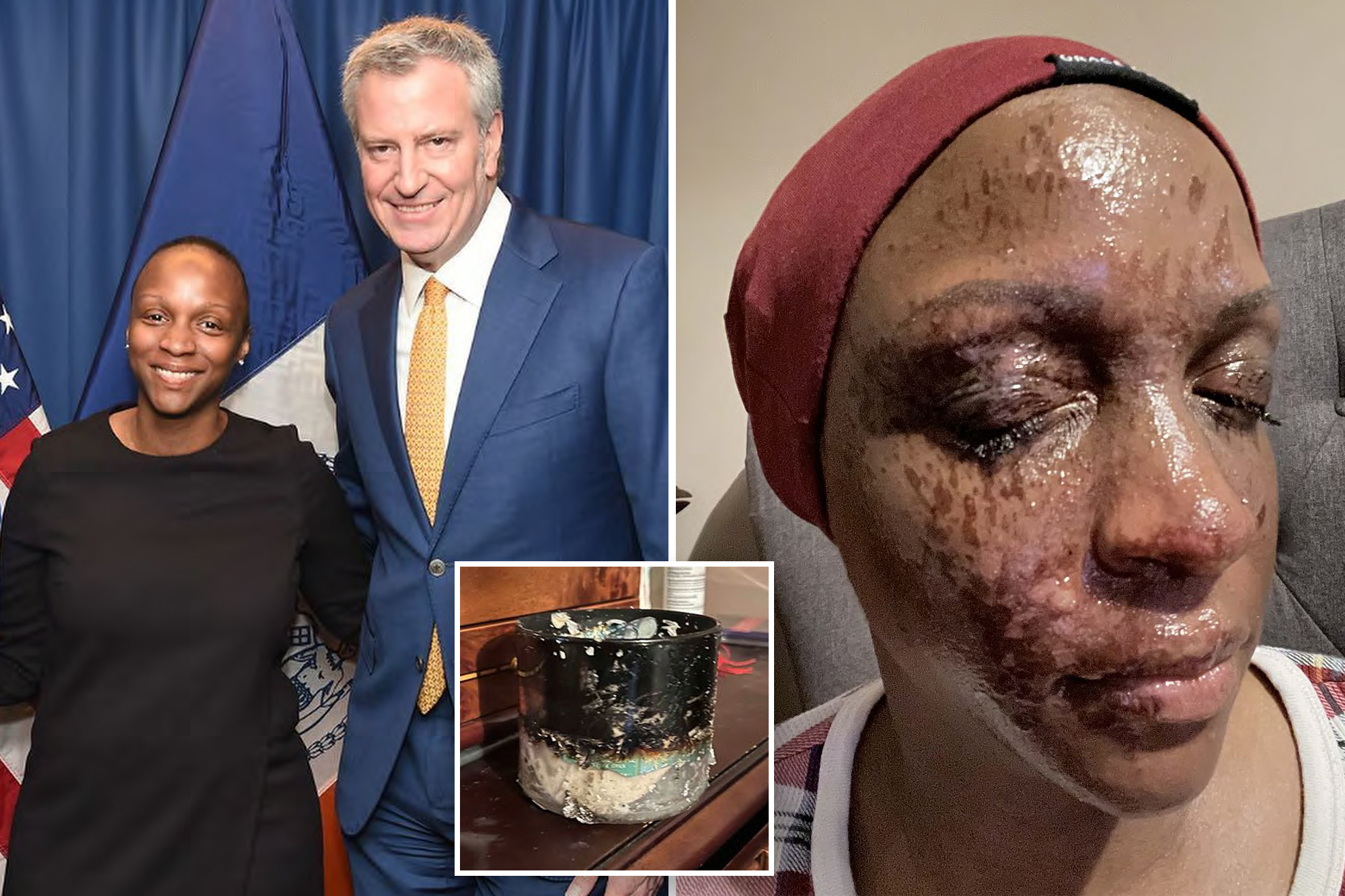 Former NYC official’s face ‘sizzled’ after Bath & Body Works candle exploded: suit