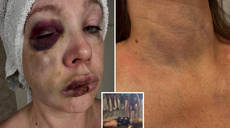 Gruesome photos show severely battered face of the woman knocked out during horrifying Cincinnati brawl