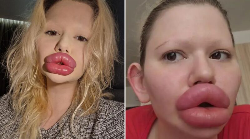 She is known as the woman with the ‘world’s largest lips’— here’s what she looked like before all her surgeries