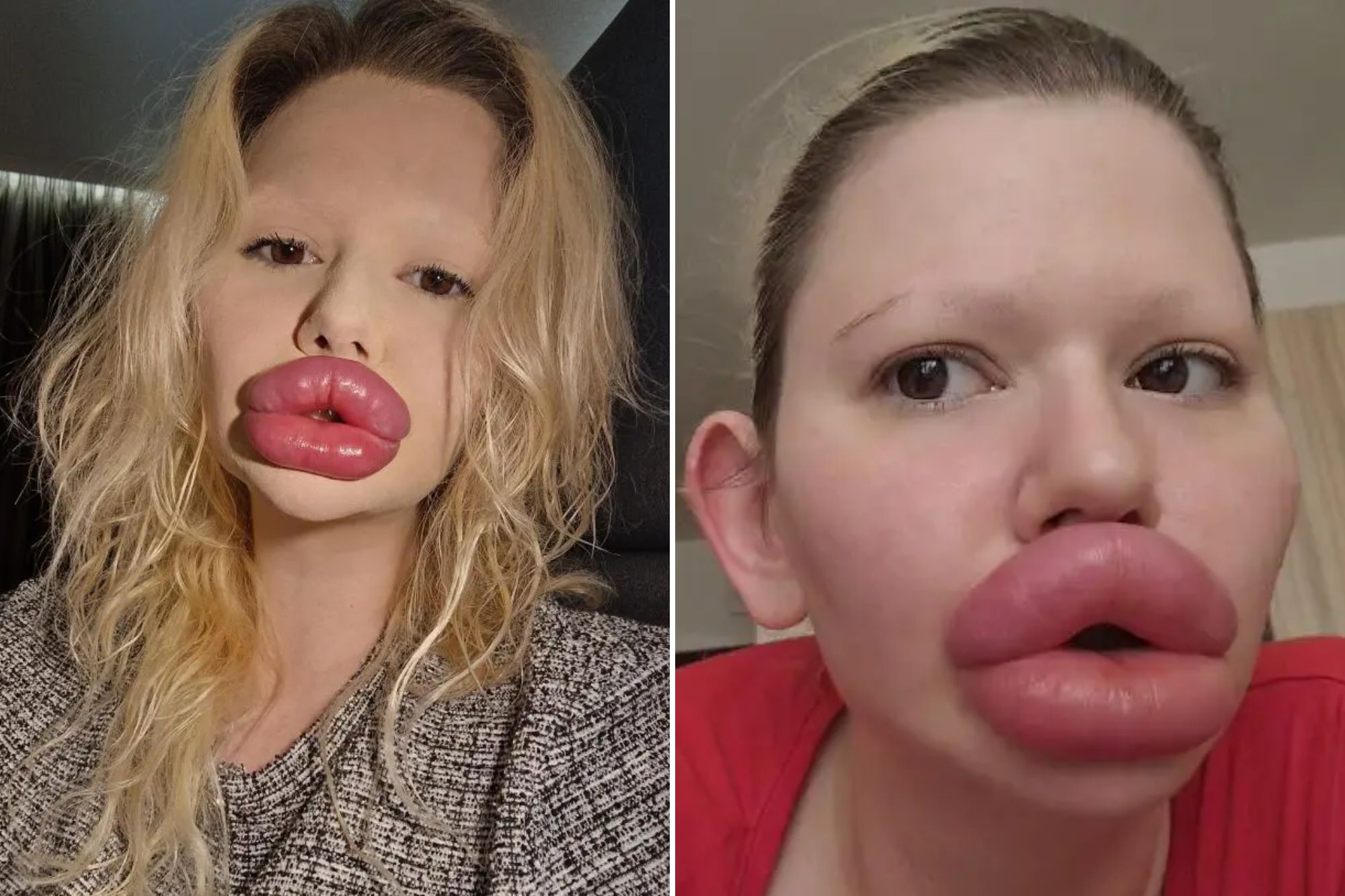 She is known as the woman with the ‘world’s largest lips’— here’s what she looked like before all her surgeries