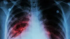 Tuberculosis case identified in Avery County