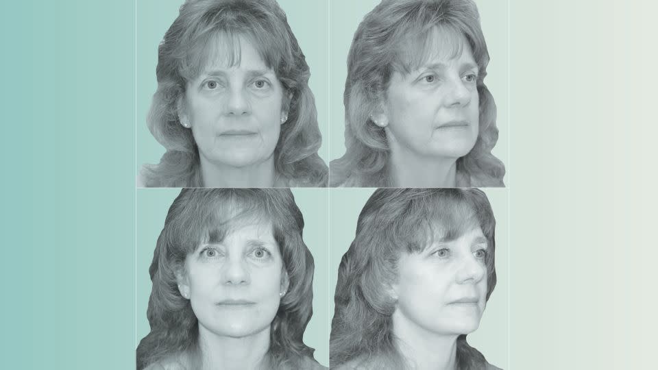 ‘Ozempic face’ may be driving a cosmetic surgery boom
